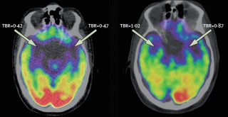 Study Reveals Path Linking Stress and Heart Health